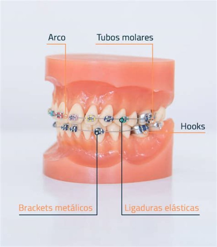 ¿Cuál es el costo de los brackets metalicos?